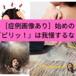 ［症例画像あり］始めの『ピリッ！』は我慢するな！